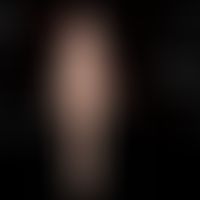 Herpes simplex recidivans: unterschiedliche Manifestationen der HSV-Infektionen (variiert n. S. L...