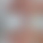 Porphyria cutanea tarda: Handrücken und dorsale Unterarme mit kleinen Papeln, Exkoriationen und ä...
