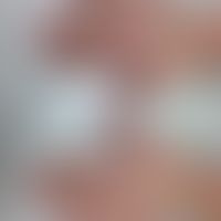 Porphyria cutanea tarda: Handrücken und dorsale Unterarme mit kleinen Papeln, Exkoriationen und ä...