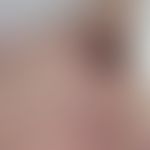 Ulzeriertes Melanom: 8 cm großes, knotig ulzeriertes (weitgehend amelanotisches) Melanom an der F...