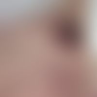 Ulzeriertes Melanom: 8 cm großes, knotig ulzeriertes (weitgehend amelanotisches) Melanom an der F...
