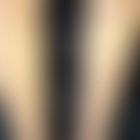 Flashlamps (side effects of the therapy): streaky hypopigmentation after IPL depilation, hair gro...