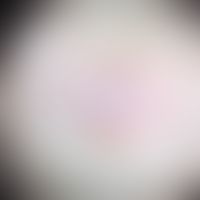 Knotig polypoides collagenoma, (solitary, nodular non-pigmented lesion).Dermatoscopy: Radially ar...