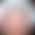 Dermatoskopie: &nbsp;Periodische, streifenförmige (seit Jahren bestehende)&nbsp;Weißfärbungen der...
