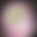 Chloronychia (around green nails): bland-greenishdiscoloration of the nail, little finger, bacter...