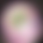 Chloronychia (around green nails): bland-greenishdiscoloration of the nail, little finger, bacter...