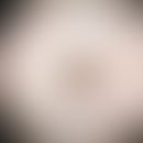 Ink spot lentigo: characteristic criteria are sharp demarcation, dark brown-black reticular lines...