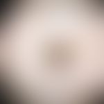 Ink spot lentigo: characteristic criteria are sharp demarcation, dark brown-black reticular lines...