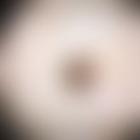 Ink spot lentigo: characteristic criteria are sharp demarcation, dark brown-black reticular lines...