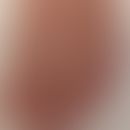 half and half nail: zonal, sharply bordered white coloration of the proximal and brown coloration...