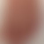 Acrocyanosis: Mild acrocyanosis in polyneuropathy. Half and half nails.

The figure was kindly pr...