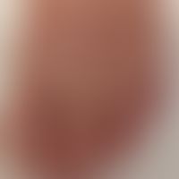 Acrocyanosis: Mild acrocyanosis in polyneuropathy. Half and half nails.

The figure was kindly pr...
