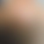 Talgdrüsenepitheliom: langsam wachsender, hautfarbener, nicht schmerzhafter, fester Knoten. &nbsp;
