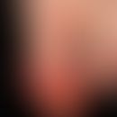 Anonychie bei Acrodermatitis chronica atrophicans. Hämorrhagisches Nagelbett. Pustulöse und ekzem...