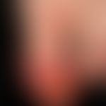 Anonychia in acrodermatitis cronica atrophicans. hemorrhagic nail bed. pustular and eczematous pa...