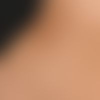Becker nevus: extensive hyperpigmentation in the area of the right hip in a 7-year-old boy, exist...