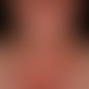 UV-Recall: UV-irradiation of the face and upper thoracic region that has been in the past for a l...
