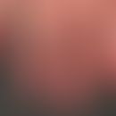 Kryoglobulinämie: deutliche, gering schmerzhafte Akrozyanose bei geringer Kälteeinwirkung.
