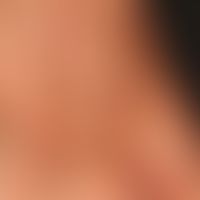 Differenzialdiagnose "Purpura senilis":&nbsp; Detailaufnahme. unterschiedlich alte, spritzerartig...