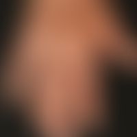 Differenzialdiagnose "Purpura senilis":&nbsp; unterschiedlich alte, spritzerartige rote Flecken n...