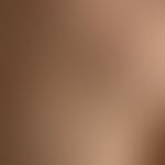 Comedo: multiple, differently sized, closed comedones (whiteheads, which are easily recognizable ...