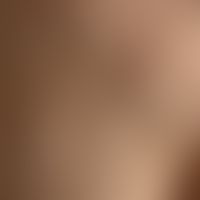 Comedo: multiple, differently sized, closed comedones (whiteheads, which are easily recognizable ...