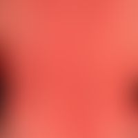 Drug exanthema: Macular, moderately itchy exanthema that occurred 5 days after taking an antibiot...
