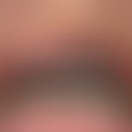 Argyrie: lokalisierte Argyrie der Lippenregion und der Mundschleimhaut.
