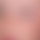 Ephelids: in summer occurring, symmetrically localized bizarre pigment spots barely 0.2cm in size...