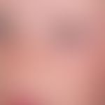 Ephelids: in summer occurring, symmetrically localized bizarre pigment spots barely 0.2cm in size...