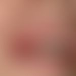 Erythema multiforme: erosive-crusty changes of the lower and upper lip with distinct swelling of ...