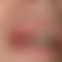 Erythema multiforme:&nbsp; erosiv-krustige Veränderungen an Unter- und Oberlippe mit deutlicher S...