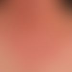 Airborne Contact Dermatitis: Subakute, unscharf begrenzte, rote&nbsp;Plaque. Der unscharfe Überga...