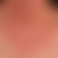 Airborne Contact Dermatitis: Subakute, unscharf begrenzte, rote&nbsp;Plaque. Der unscharfe Überga...