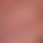 Angiokeratoma scroti (detail): Chronically stationary, multiple, disseminated but also grouped (c...