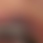 Argyrie (Detail): lokalisierte Argyrie der Lippenregion und der Mundschleimhaut. Bei stärkerer Ve...