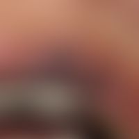 Argyrie (Detail): lokalisierte Argyrie der Lippenregion und der Mundschleimhaut. Bei stärkerer Ve...
