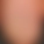 Alopecia areata totalis: non-transparent (opaque) trachyonychia (sandpaper nail) with flat, grey ...