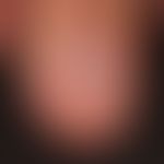 Lichen planus der Nägel: kompletter Verlust des Nagels (Anonychie).&nbsp;
