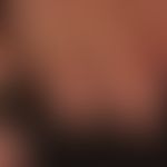 Lichen planus der Nägel: nahezu kompletter Verlust der Nägel mit flächigem Pterygium. &nbsp;
