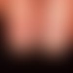 Lichen planus der Nägel: raue Oberfläche der Nägel (Trachyonychie) bei bekanntem exanthematischem...