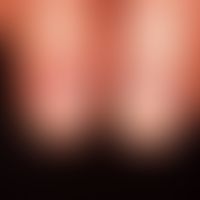 Lichen planus of the nails: rough surface of the nails (trachyonychia) with known exanthematic li...