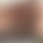 Benzyl nicotinate: toxic reaction after application of the cosmetic product "Lip Injection" on th...