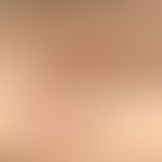 Benzyl nicotinate: toxic reaction after application of the cosmetic "Lip Injection" on the forear...