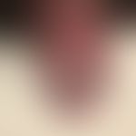 Candia-Balanitis: acute (within 1 day) after GM, itchy, flat erythema and plaques, papules and ve...
