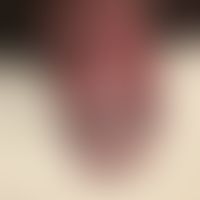 Candia-Balanitis: acute (within 1 day) after GM, itchy, flat erythema and plaques, papules and ve...