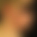 Acne papulopustulosa: Massive exacerbation of acne papulopustulosa as a rare side effect 6 weeks ...