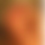 Chondrodermatitis nodularis chronica helicis: 64 Jahre alte Patientin mit schmerzhafter Knötchenb...