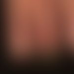 Ulcer of the skin: complete necrosis of the end phalanx in previously known psoriatic systemic sc...