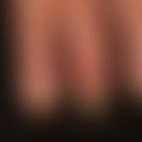 Ulcer of the skin: complete necrosis of the end phalanx in previously known psoriatic systemic sc...